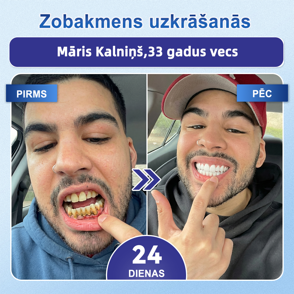 GarageLine®🦷8️⃣ TIDEGLUSIB ZOBU UN SMAGANU NanoLabošanas Šķīstošās Balinošās Sloksnes✨ (Atbalsta zobu atjaunošanu un palīdz mazināt smaganu diskomfortu un citas bieži sastopamas mutes dobuma problēmas